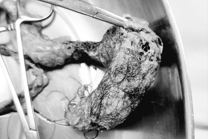 Búi tóc có lẫn bã thức ăn dài 12cm trong ruột bé gái 4 tuổi. (Nguồn: Tiền phong)