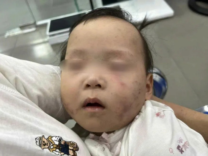 Bé gái hơn 1 tuổi được gia đình phát hiện bầm tím mặt sau khi từ cơ sở nhà trẻ về nhà.