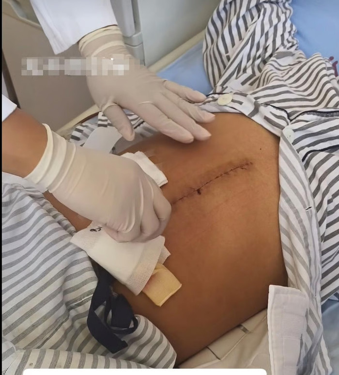 Chàng trai hiến gan cứu con gái, xuất viện sớm và tự thay băng hậu phẫu thuật để tiết kiệm tiền Ảnh 3