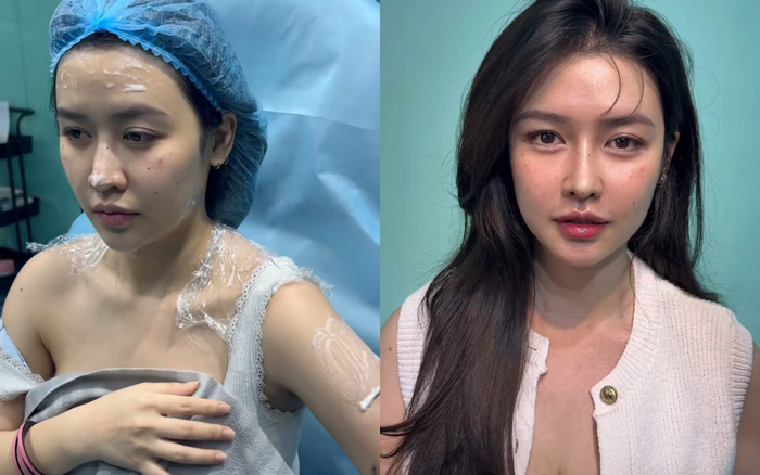 Quyên Qui trước và sau khi 'trùng tu' khuôn mặt. Ảnh: H.C