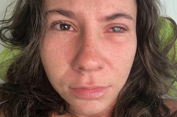 Đeo kính áp tròng, cô gái 21 tuổi gặp tình trạng có thể dẫn đến mù lòa Ảnh 3