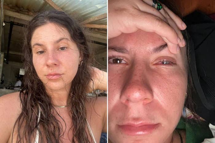 Đeo kính áp tròng, cô gái 21 tuổi gặp tình trạng có thể dẫn đến mù lòa Ảnh 2