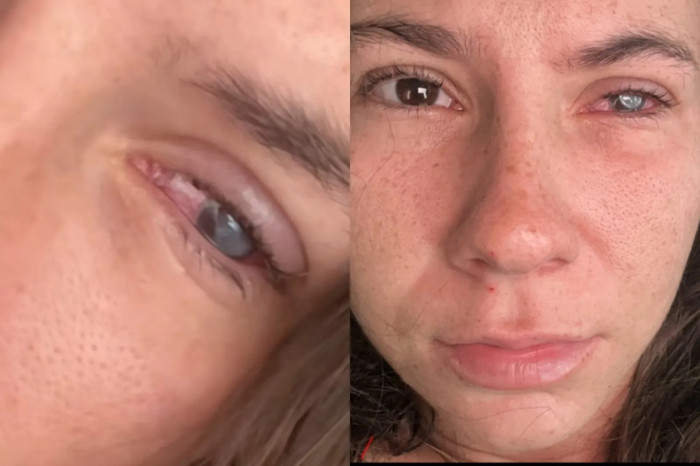 Đeo kính áp tròng, cô gái 21 tuổi gặp tình trạng có thể dẫn đến mù lòa Ảnh 1