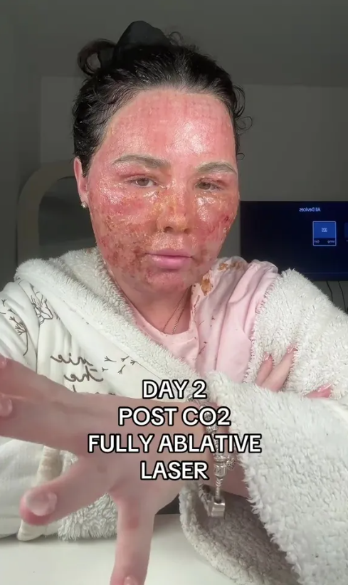 Stevie đã khoe kết quả sau khi điều trị bằng laser CO2 và thừa nhận tình trạng 'ngày càng tệ hơn' và trông 'kinh khủng'. Ảnh: tiktok/@steviethatautisticbaddie