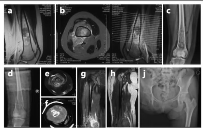 Vào năm 2023 và 2024, bệnh ung thư của bà tái phát, di căn đến phổi, và gần đây bà đã phát hiện một khối u mới ở màng phổi. Ảnh: QQ.com