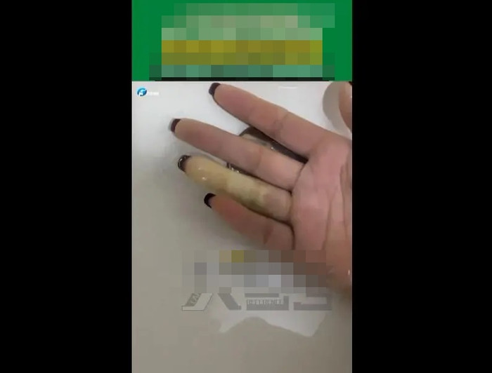 Ngón tay bỗng đổi màu trắng bệch như 'xúc xích', người phụ nữ gặp hiện tượng ít ai ngờ Ảnh 1