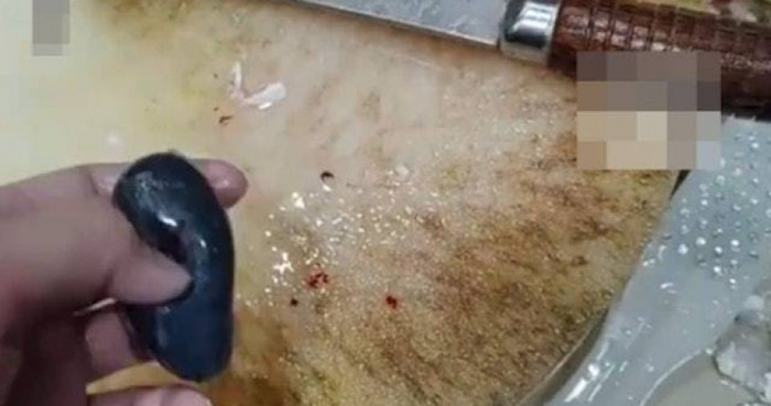 Nghe theo 'mẹo dân gian' nuốt sống mật cá để chữa đau đầu, người phụ nữ nguy kịch Ảnh 1