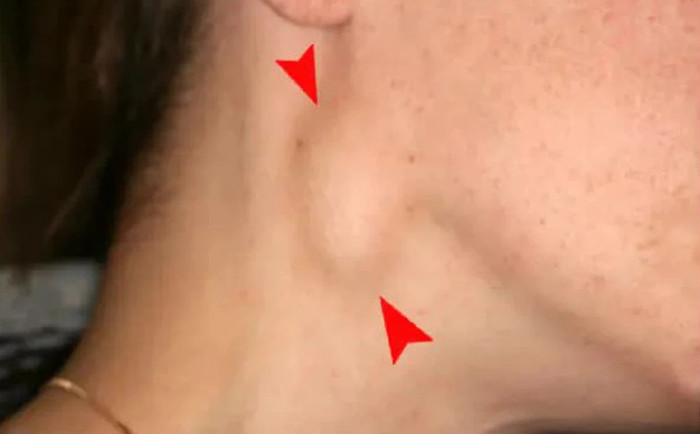 Khi cơ thể xuất hiện dấu hiệu này cần tới bệnh viện ngay kẻo ung thư vòm họng Ảnh 3