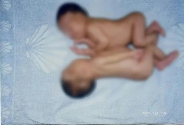 Cặp song sinh dính liền được 'tách rời', 28 năm sau phép màu xảy ra ai cũng xúc đông Ảnh 2