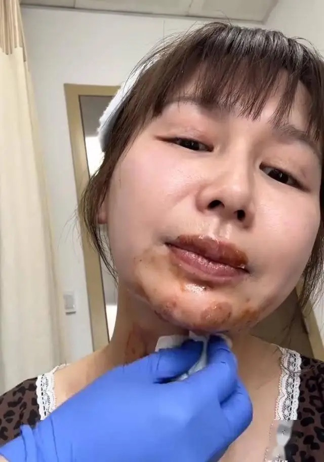 Bắt trend 'bánh sinh nhật phun lửa', nữ diễn viên 27 tuổi gặp tai nạn kinh hoàng Ảnh 4