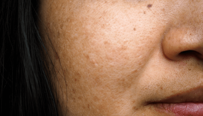 3 thay đổi nhỏ trên da có thể là tín hiệu cảnh báo bệnh tiểu đường Ảnh 1