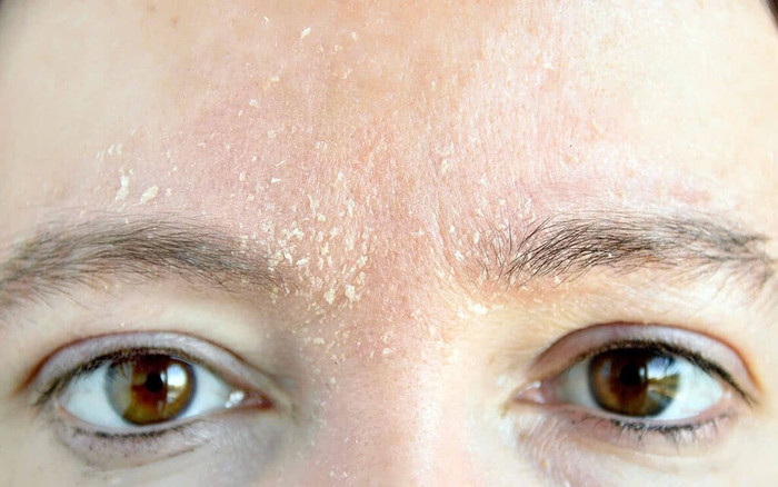 3 thay đổi nhỏ trên da có thể là tín hiệu cảnh báo bệnh tiểu đường Ảnh 2