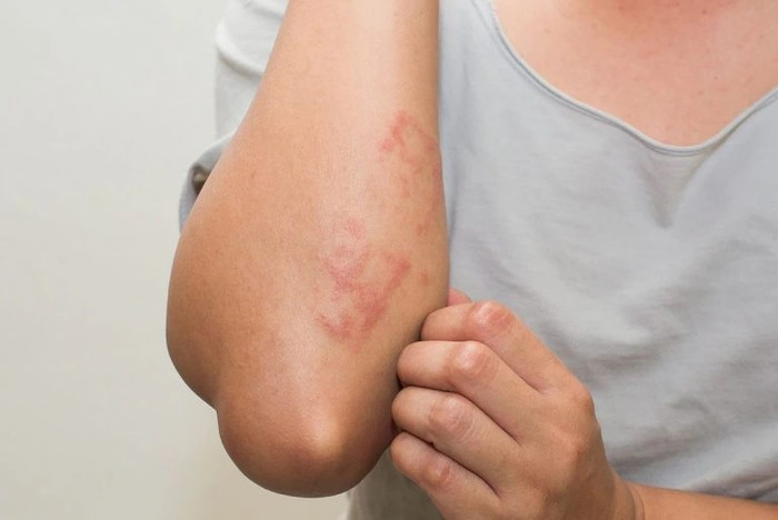 Vì sao ngày càng nhiều người trẻ mắc gan nhiễm mỡ dù không uống rượu? Ảnh 4