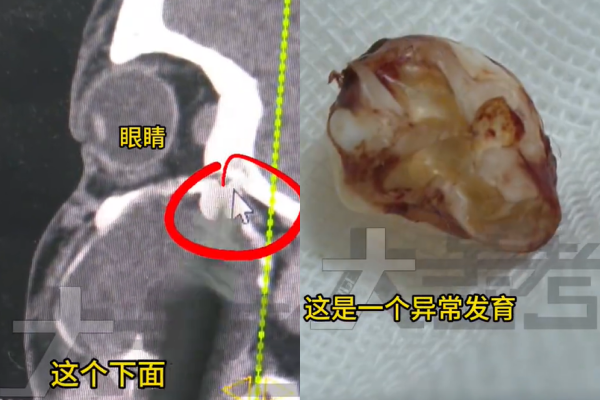 Bé trai 15 tuổi mặt sưng, miệng méo, đi chụp CT bác sĩ phát hiện sự thật bất ngờ Ảnh 3