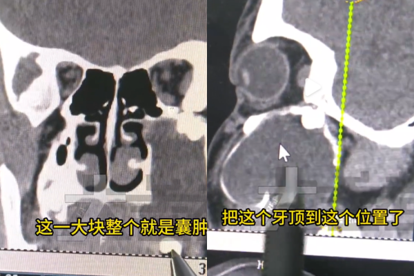 Bé trai 15 tuổi mặt sưng, miệng méo, đi chụp CT bác sĩ phát hiện sự thật bất ngờ Ảnh 1