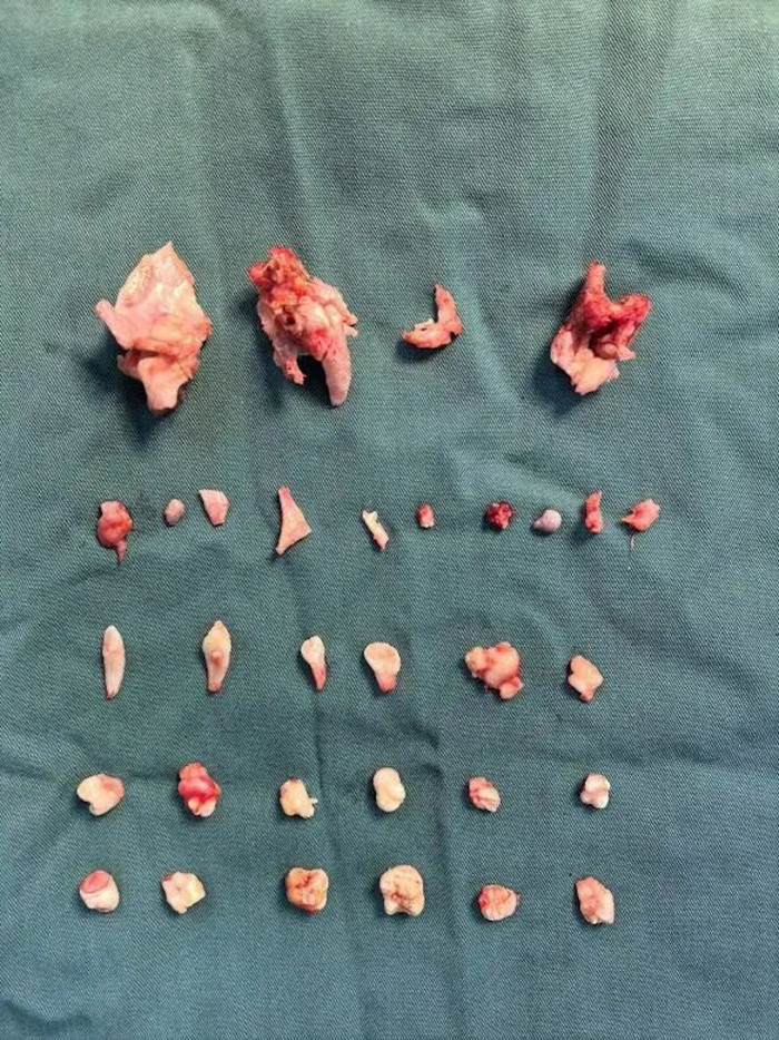 Cô gái đau bụng dữ dội khi tập thể dục, bác sĩ 'sốc' khi lấy ra 24 chiếc răng trong bụng Ảnh 3