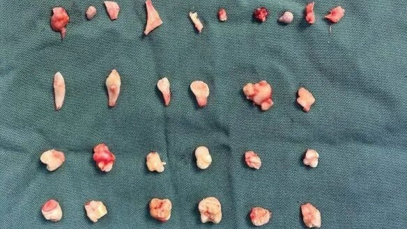 Cô gái đau bụng dữ dội khi tập thể dục, bác sĩ 'sốc' khi lấy ra 24 chiếc răng trong bụng Ảnh 2