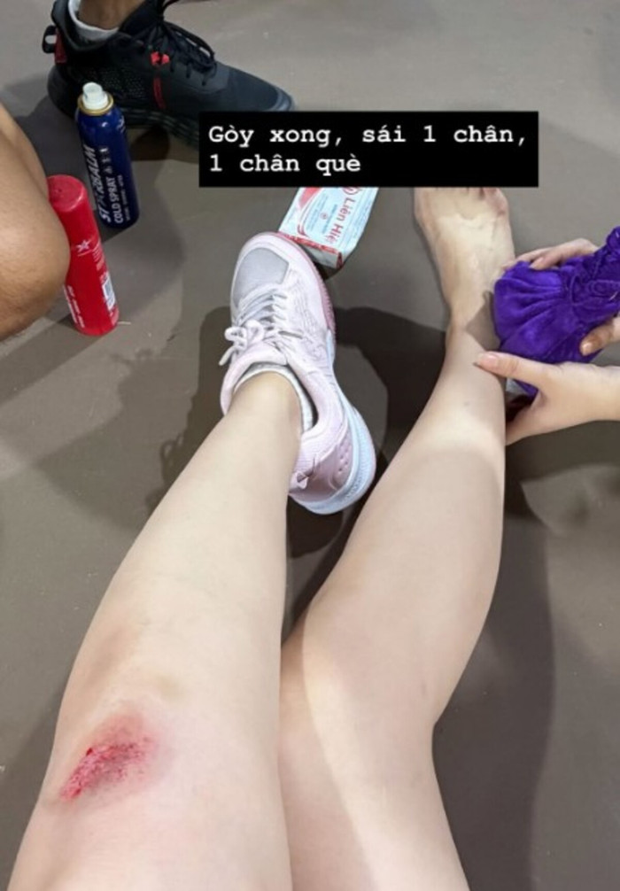 Phần chân bị thương của Á hậu Huyền My. Ảnh: IGNV