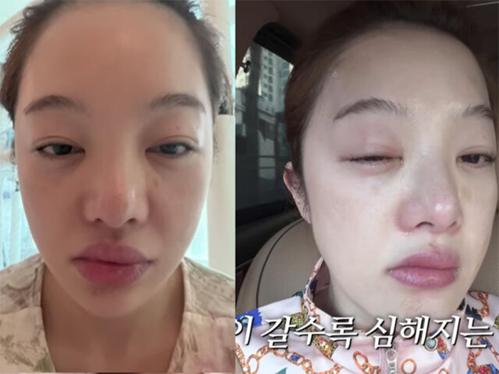 Tình trạng của nữ diễn viên Hwang Bo Ra khiến nhiều người xót xa.