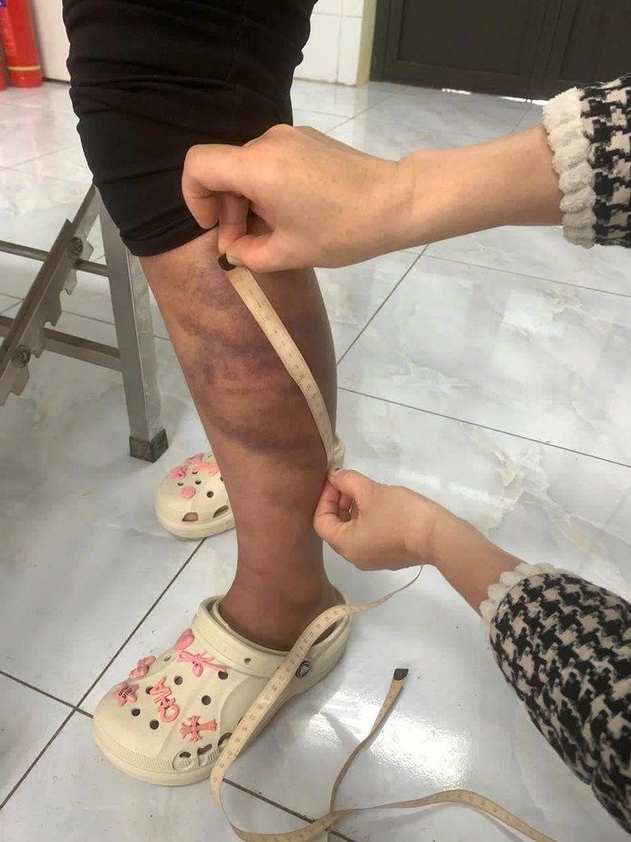 Những vết bầm trên cơ thể bị hại.&nbsp;