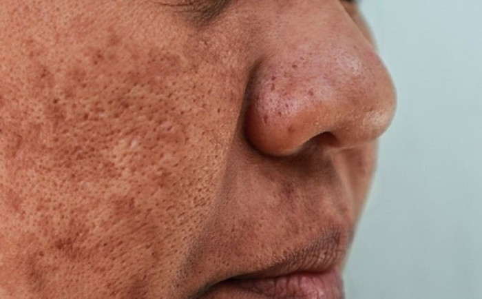 Chúng ta nên duy trì lối sống lành mạnh để cải thiện làn da. Ảnh minh hoạ