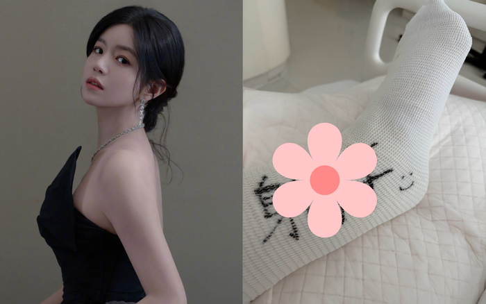 Trần Nghiên Hy bó bột chân sau sự cố ngoài ý muốn. Ảnh: Weibo