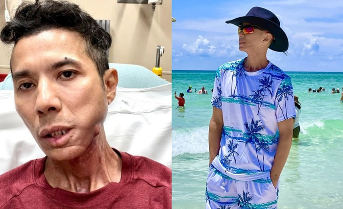 Ngoại hình Kasim Hoàng Vũ sau khi phẫu thuật xương quai hàm. Ảnh: FBNV