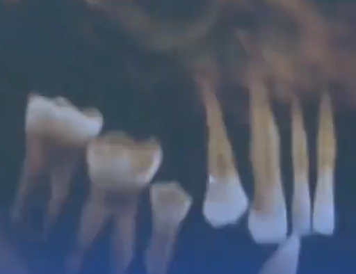 Người đàn ông 44 tuổi nhổ 14 chiếc răng, nguyên nhân khiến ai cũng xôn xao Ảnh 1