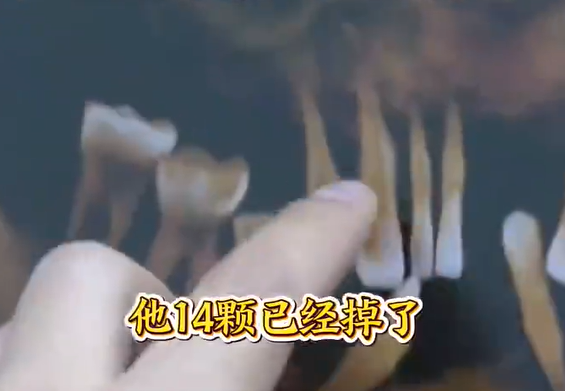 Người đàn ông 44 tuổi nhổ 14 chiếc răng, nguyên nhân khiến ai cũng xôn xao Ảnh 2