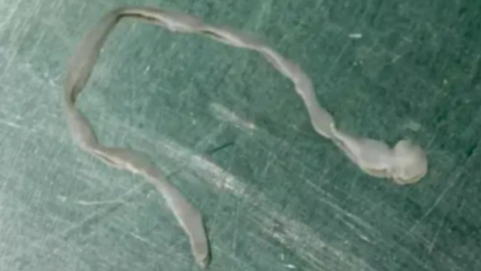 Người phụ nữ nhập viện vì bị ớn lạnh, bác sĩ kinh hoàng khi lấy ra thứ trong đầu Ảnh 2