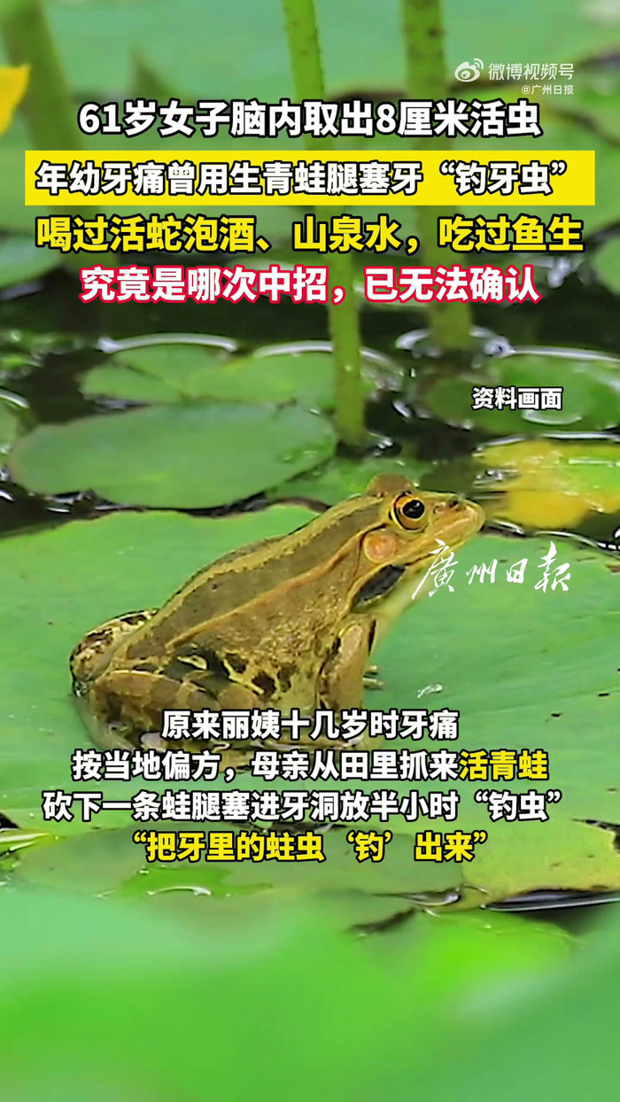 Người phụ nữ nhập viện vì bị ớn lạnh, bác sĩ kinh hoàng khi lấy ra thứ trong đầu Ảnh 3