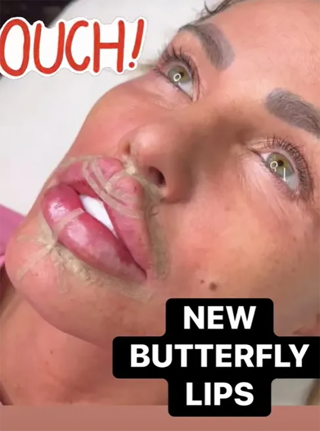 Katie Price khoe diện mạo mới khi phẫu thuật thẩm mỹ theo xu hướng môi 'cánh bướm'.