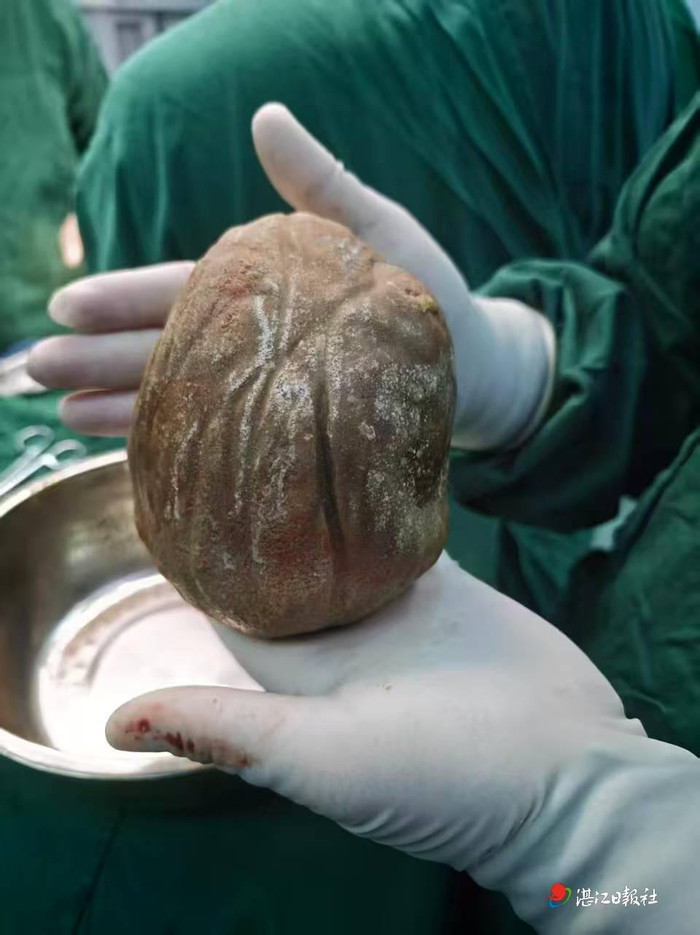 Viên sỏi bàng quang khổng lồ này nặng 1,3 kg và có kích thước bằng khoảng hai nắm tay người lớn. (Báo Zhanjiang Daily).