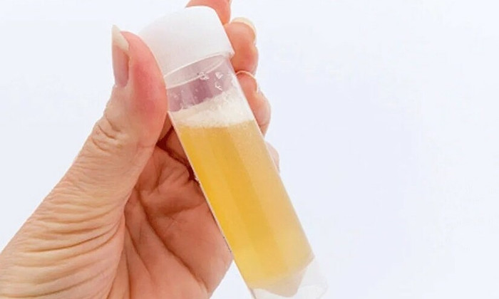 Nước tiểu có mùi nồng.