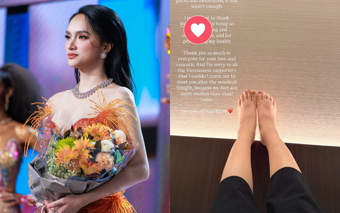 Đôi chân của Hương Giang bị sưng sau một thời gian liên tục đi giày cao gót khi tham gia cuộc thi MGI All Stars. Ảnh: IGNV