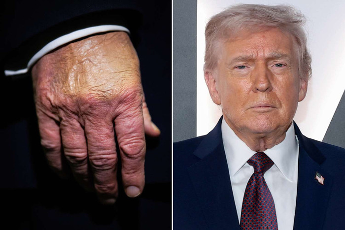 Donald Trump và bàn tay của ông ấy (Ảnh: Samuel Corum/Getty; Dimitrios Kambouris/Getty)&nbsp;