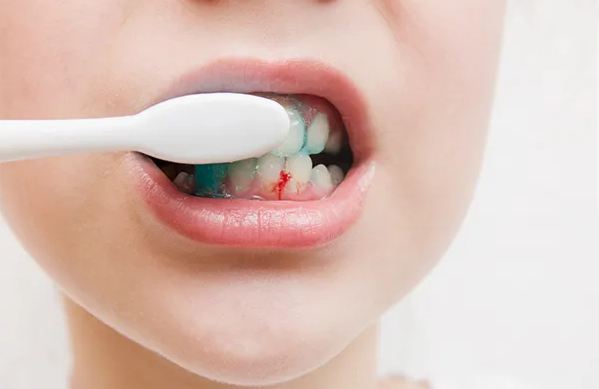 Những sai lầm khi đánh răng khiến răng ngày càng yếu dù vệ sinh đều đặn Ảnh 1