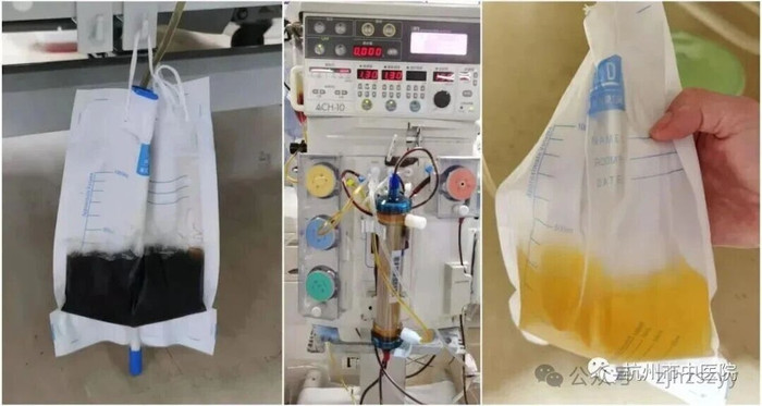 Người đàn ông bị rắn cắn khi quét sân, nước tiểu chuyển màu đen (Bệnh viện Y học Cổ truyền Thành phố Hàng Châu).