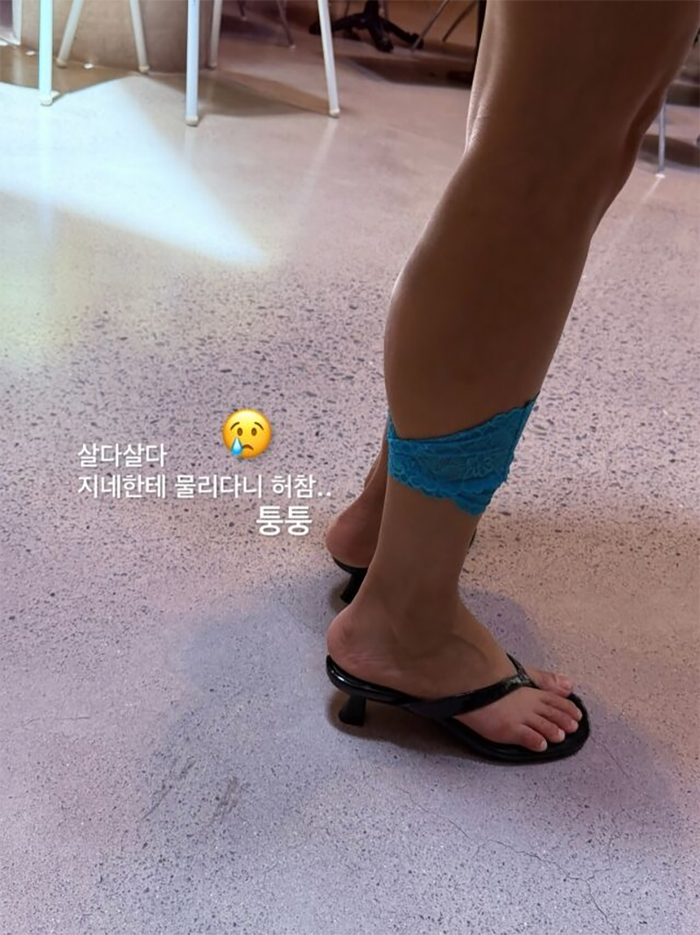 Cùng bài đăng, Jin Jae Young công khai hình ảnh chân bị thương.