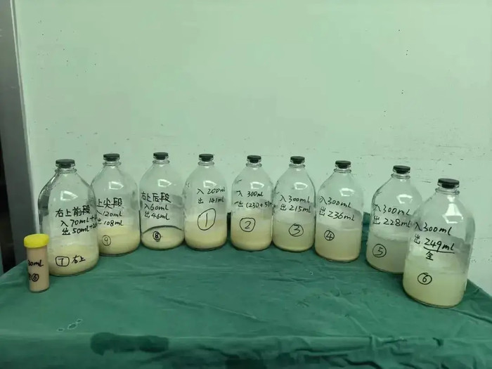 Bé gái 6 tuổi ho suốt 2 tháng, bác sĩ lấy ra thứ trong phổi gây bàng hoàng Ảnh 1