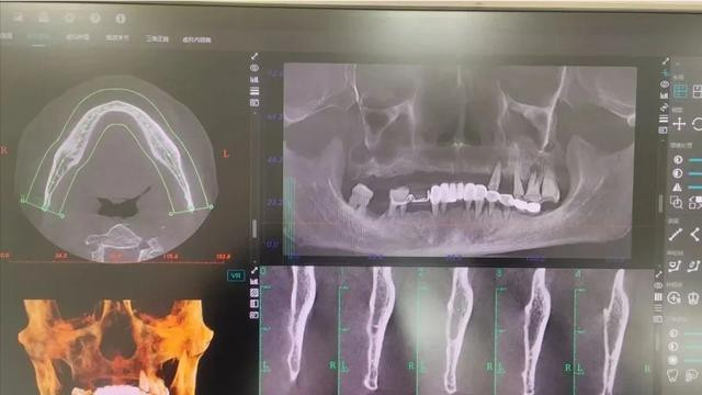 Cụ ông 63 tuổi đi khám một chiếc răng đau, bệnh viện nhổ cùng lúc 12 chiếc gây bàng hoàng Ảnh 4