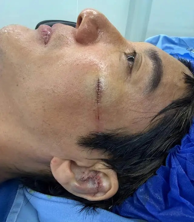 Vương Lực Hoành khâu 39 mũi sau tai nạn trên sân khấu Ảnh 1