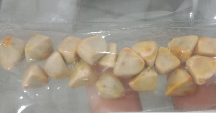 Uống trà đá mỗi ngày trong suốt 10 năm, người phụ nữ tích tụ cả 'ổ' sỏi thận Ảnh 1