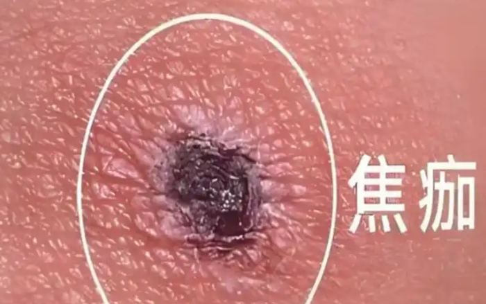 Xuất hiện vết lạ trên da đầu nhưng chủ quan, người phụ nữ 56 tuổi rơi vào nguy kịch Ảnh 1