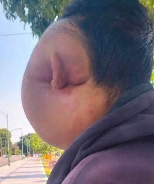 Người đàn ông bị biến dạng khuôn mặt kinh hoàng sau khi dùng tăm xỉa răng Ảnh 2