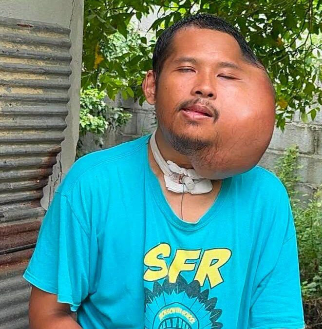 Người đàn ông bị biến dạng khuôn mặt kinh hoàng sau khi dùng tăm xỉa răng Ảnh 1