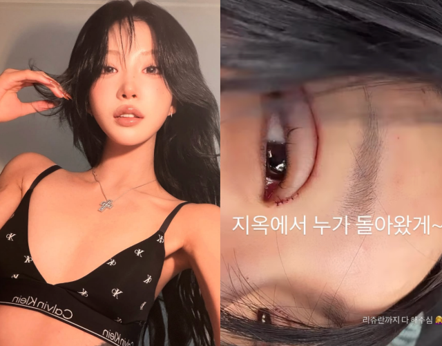 Choi Joon Hee, con gái của cố diễn viên Choi Jin Sil và là một influencer, đã công khai hình ảnh của mình ngay sau khi thực hiện phẫu thuật thẩm mỹ mắt. Ảnh: Choi Joon Hee