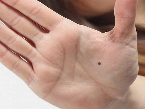 Những vị trí nốt ruồi được quan niệm mang lại may mắn, hậu vận giàu sang Ảnh 6