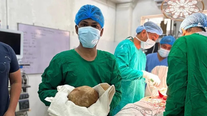 Các bác sĩ ở Sri Lanka đã phẫu thuật lấy ra một viên sỏi bàng quang khổng lồ nặng bằng một đứa trẻ sơ sinh (Ảnh: BBC)&nbsp;