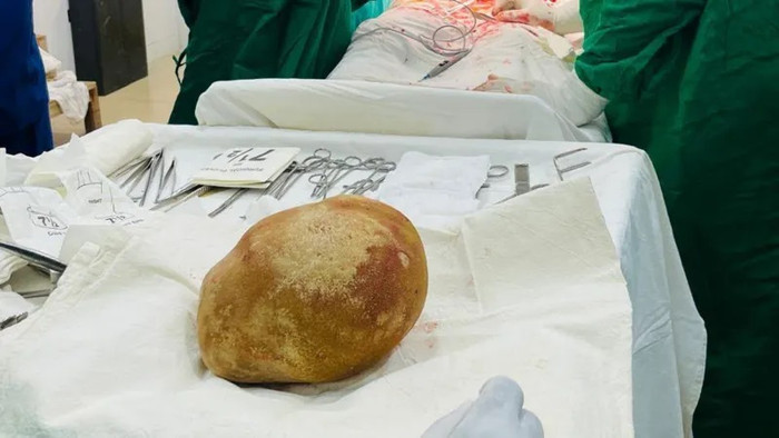 Viên sỏi bàng quang có đường kính khoảng 17cm, kích thước bằng một quả trứng đà điểu (Ảnh: BBC)&nbsp;